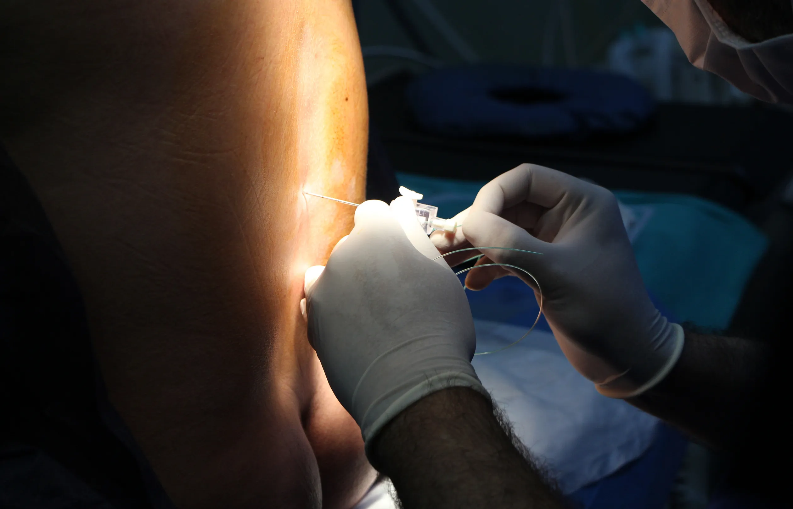 epidural anesthesia - Oficial